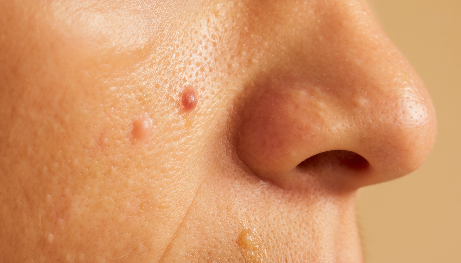 What Is iPledge? A Complete Guide to the Program Patients Must Join for ...