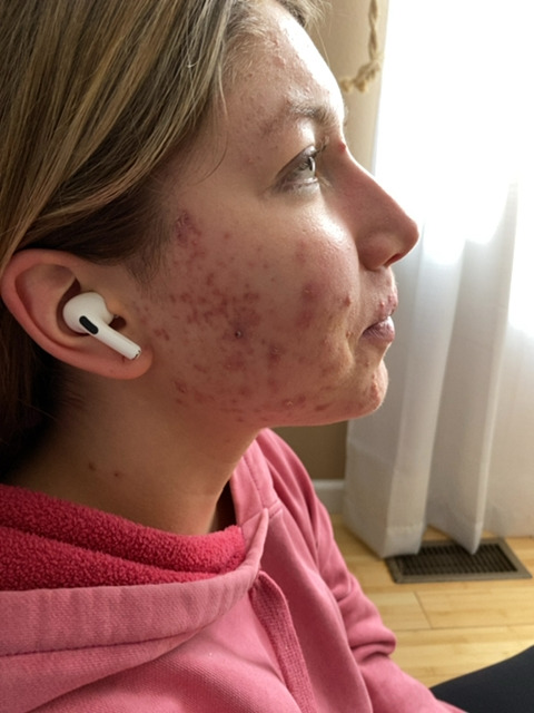 Emma before treatment