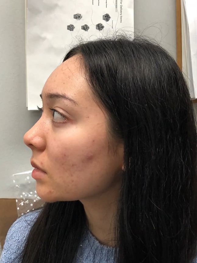 Holly before treatment