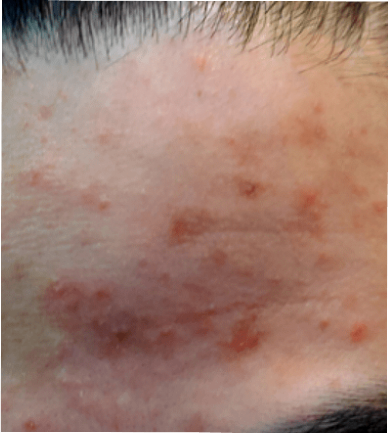 Michael before treatment