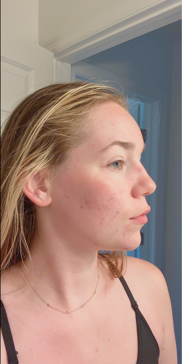 Caitlin after treatment