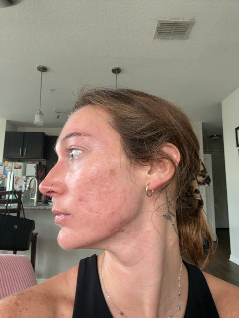 Ashley O. after treatment