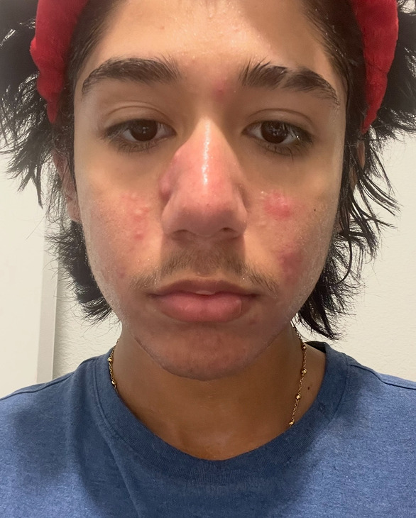 Luis G. before treatment